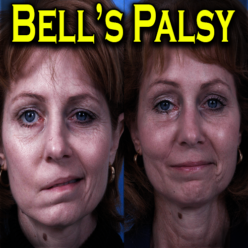 Bell's Palsy