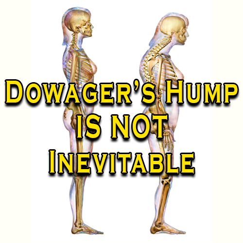 Dowager’s Hump is Not Inevitable