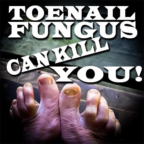 Toenail Fungus Can Kill You