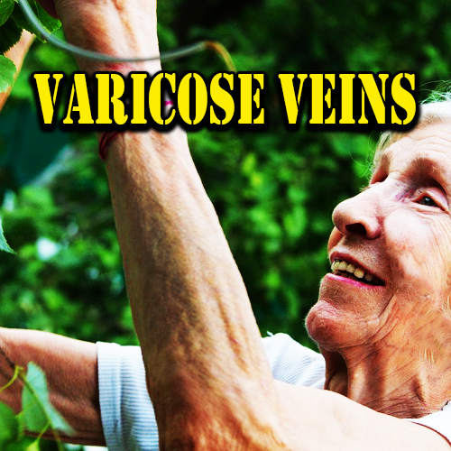 Varicose Veins