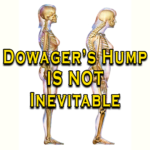 Dowager's Hump Is Not Inevitable